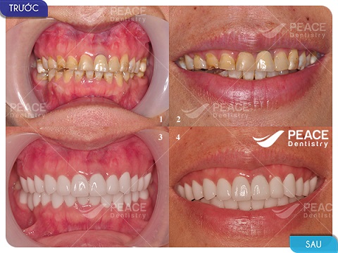 bọc răng sứ nguyên hàm zirconia ddbio