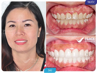 hình ảnh khách hàng bọc 20 răng sứ cercon cho răng tối màu