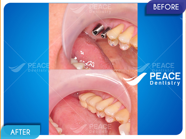 hình ảnh khách hàng implant ít răng 6