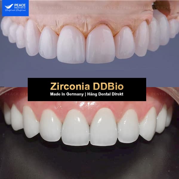 tính thẩm mỹ của răng sứ zirconia ddbio