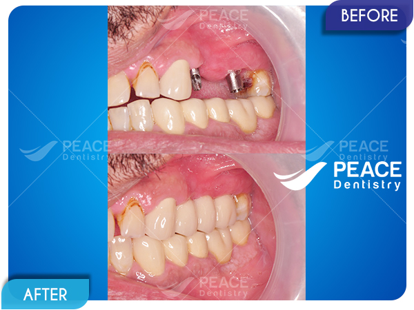 cấy 2 trụ implant khôi phục 3 răng hàm cho khách hàng úc
