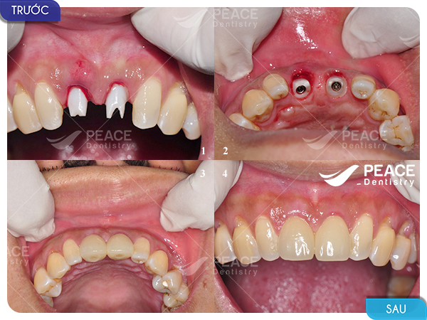 trồng 2 trụ implant neodent và răng sứ zirconia khôi phục 2 răng cửa