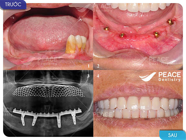 trồng răng implant toàn hàm all on 4 cho khách hàng mất gần hết răng