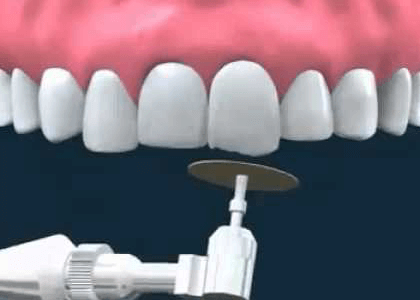 quy trình trồng răng sứ bước 3