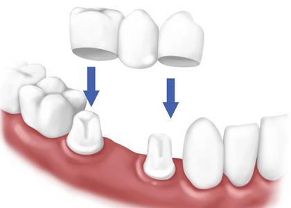 quy trình trồng răng sứ bước 5