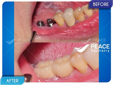 trồng răng implant cho răng hàm