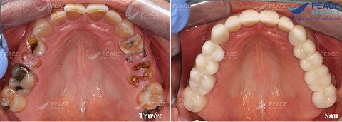 trồng răng sứ cố định 8 răng hàm
