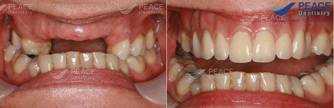 trồng răng sứ cố định cho 5 răng cửa