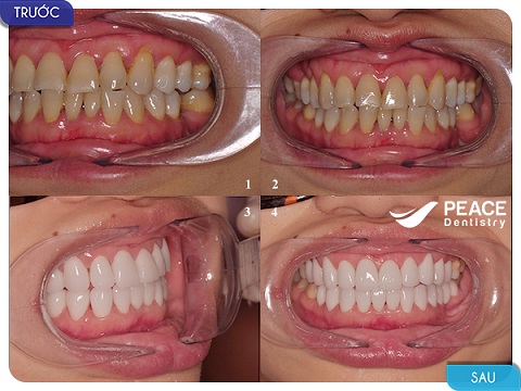 bọc 20 răng sứ nguyên hàm với sứ zirconia