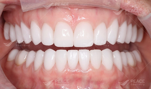 răng sứ cercon chính hãng bảo hành 10 năm