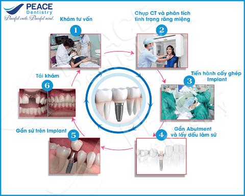 quy trình cấy ghép implant tại peace dentistry