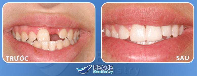 hình ảnh trồng răng sứ peace dentistry