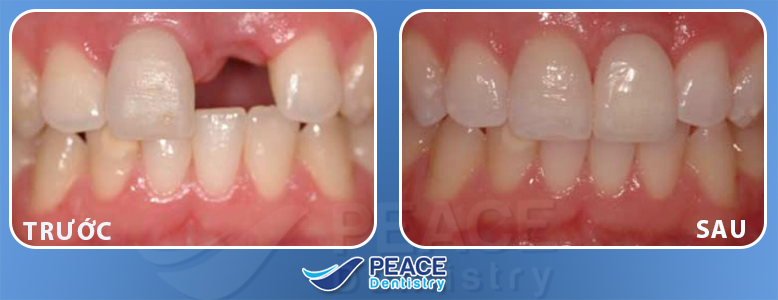trồng răng sứ tại peace dentistry