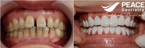 bọc 20 răng sứ zirconia zolid