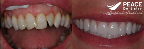 bọc sứ cho răng mọc lệch nhiễm màu
