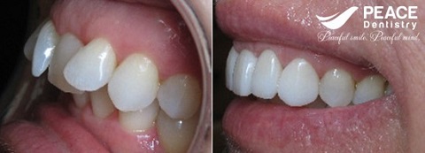 bọc 2 răng sứ cho 2 răng cửa mọc lệch