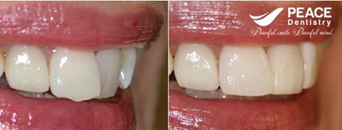 bọc 1 răng sứ cho răng cửa mọc lệch