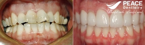 bọc 4 răng sứ cho hàm trên mọc lệch