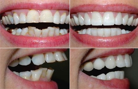bọc răng sứ cho răng mọc lệch khểnh hàm dưới