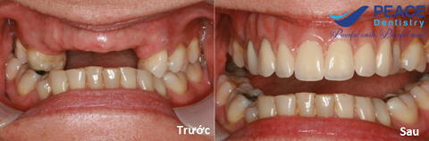 trồng răng sứ khôi phục 4 răng cửa