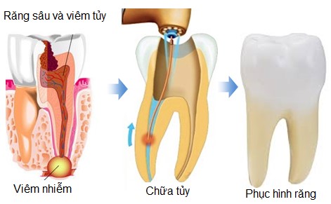 quy trình điều trị sâu răng