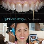 phần mềm digital smile design