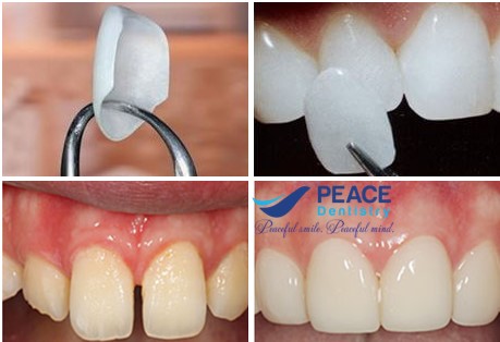 3 Phương pháp khắc phục răng thưa hiệu quả vượt trội
