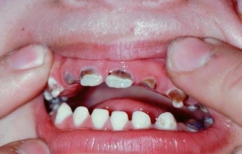 sún răng