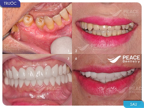 răng sứ cercon khả năng chịu lực cao