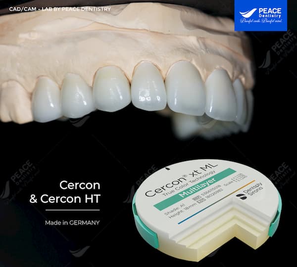 răng toàn sứ cercon