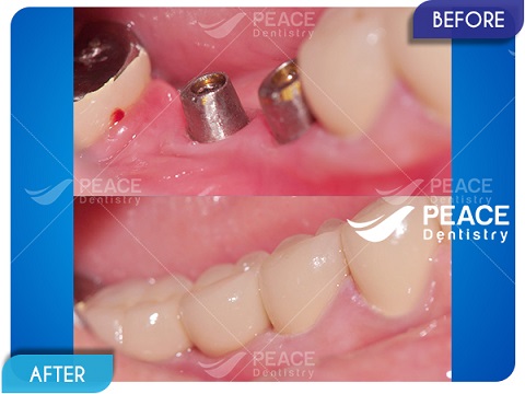 trồng răng implant cho khách hàng mất ít răng