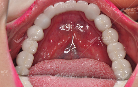 răng sứ zirconia ddbio chống bám mùi