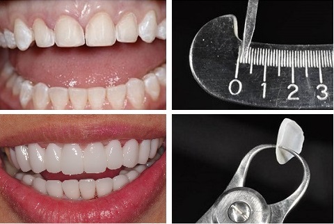 mặt dán sứ veneer bảo tồn răng thật