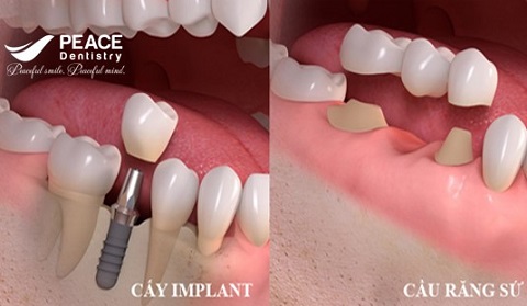 trồng răng implant không mài răng kế cận