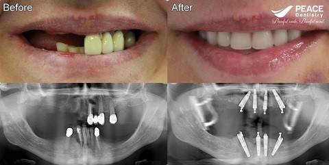 trước và sau khi trồng răng implant all on 4