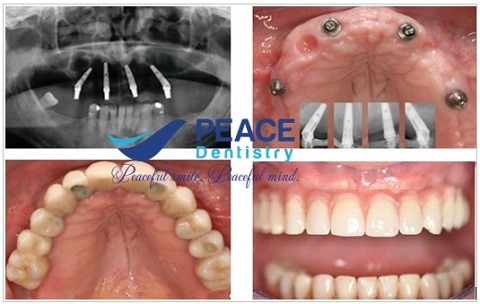 trồng răng implant all on 4 với trụ neodent