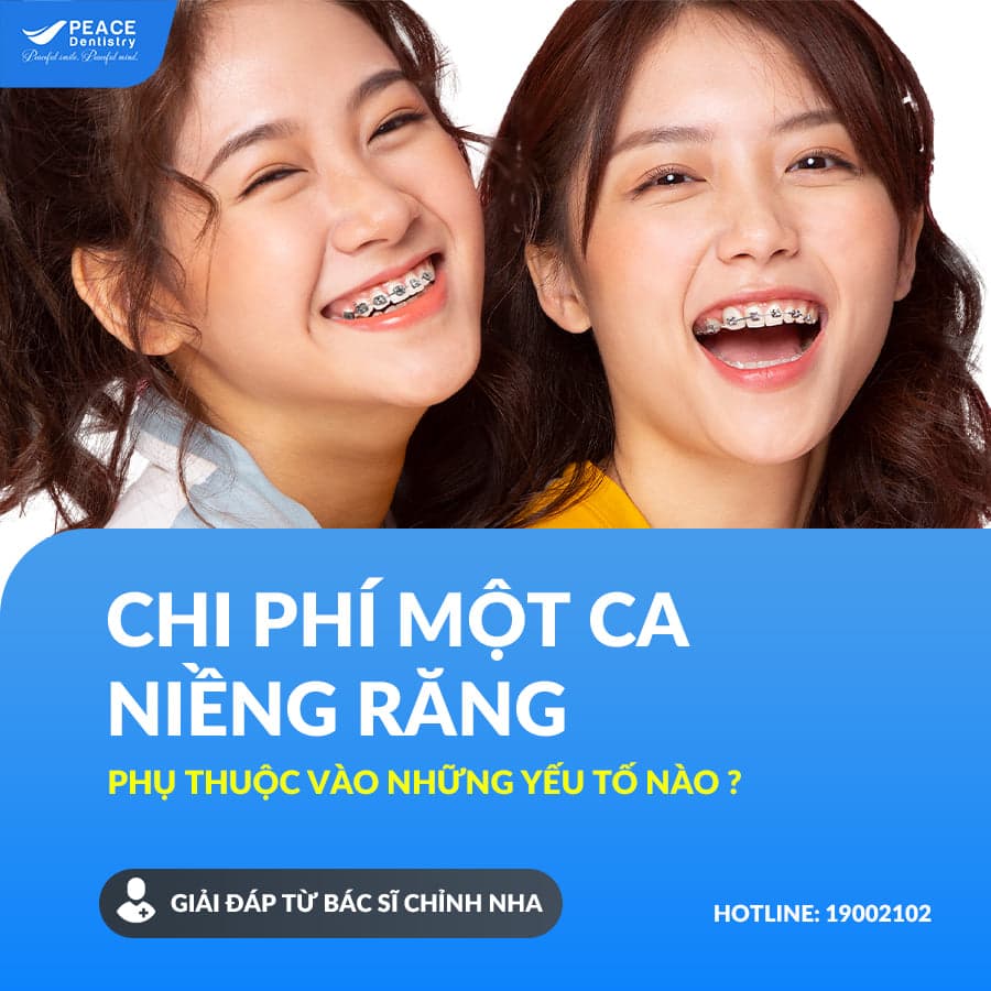 chi phí niềng răng phụ thuộc vào yếu tố nào