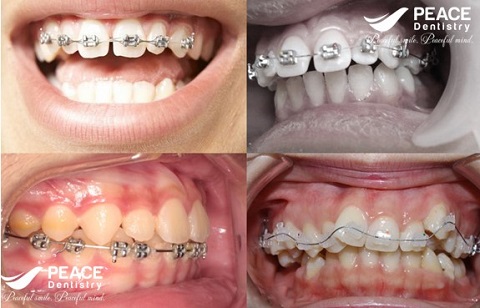 niềng răng 1 hàm cho răng hô nhẹ