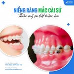 niềng răng mắc cài sứ