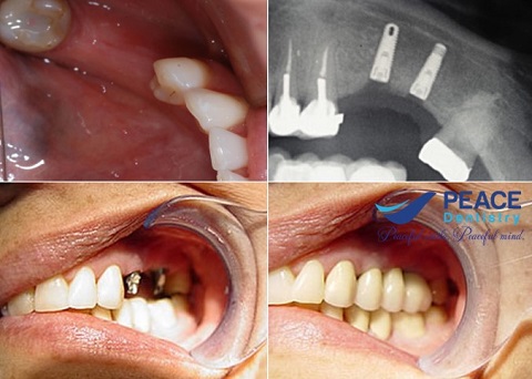 trồng implant cho 2 răng hàm