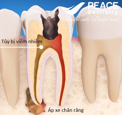 sâu răng dẫn đến viêm tủy