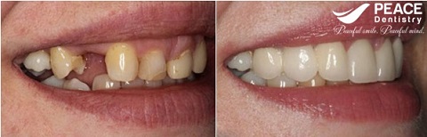 trồng răng sứ cho răng hàm