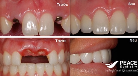 hiệu quả của trồng răng implant