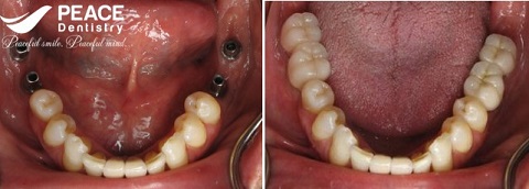 trồng răng implant khôi phục 4 răng hàm