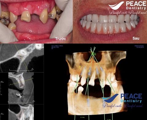 trồng răng implant all on 4 cho răng mất lâu năm
