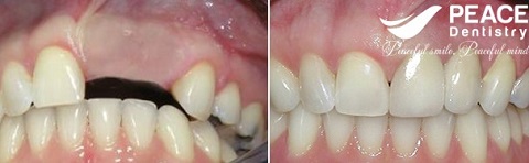 trồng răng sứ cho răng cửa