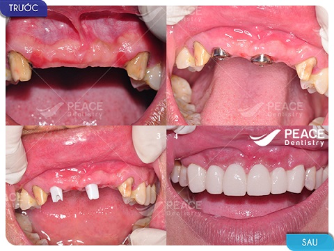 cấy 2 trụ implant khôi phục 4 răng