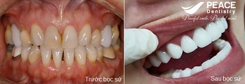 bọc 20 răng sứ cao cấp zirconia