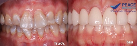 bọc răng sứ cho răng không đều nhiễm fluor