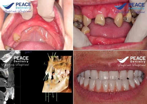 trồng răng implant all on 4 với 8 trụ implant mỹ